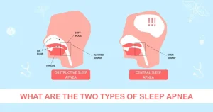 Two types of sleep apnea